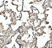 IHC testing of FFPE human lung cancer tissue with Annexin VI antibody. Required HIER: steam section in pH8 EDTA buffer for 20 min and allow to cool prior to staining.
