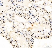 IHC staining of FFPE human renal cell carcinoma tissue with JUND antibody. HIER: boil tissue sections in pH8 EDTA for 20 min and allow to cool before testing.