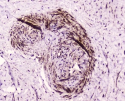 IHC testing of FFPE human placental tissue with PDGFRB antibody at 2 ug/ml. HIER: boil tissue sections in pH6, 10mM citrate buffer, for 10-20 min followed by cooling at RT for 20 min.