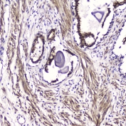 IHC testing of FFPE human prostate cancer with ATF4 antibody at 2ug/ml. HIER: boil tissue sections in pH6, 10mM citrate buffer, for 10-20 min followed by cooling at RT for 20 min.