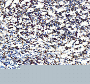 IHC staining of FFPE human appendix tissue with CD5 antibody, HRP-secondary and DAB substrate. HIER: boil tissue sections in pH8 EDTA for 20 min and allow to cool before testing.