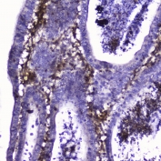 IHC testing of FFPE human intestinal cancer with Talin 1 antibody at 2ug/ml. HIER: boil tissue sections in pH6, 10mM citrate buffer, for 10-20 min followed by cooling at RT for 20 min.