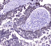 IHC testing of FFPE human lung cancer with HSP70 antibody at 2ug/ml. HIER: boil tissue sections in pH6, 10mM citrate buffer, for 10-20 min followed by cooling at RT for 20 min.