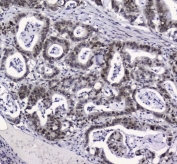 IHC testing of FFPE human intestinal cancer with APE1 antibody at 2ug/ml. HIER: boil tissue sections in pH6, 10mM citrate buffer, for 10-20 min followed by cooling at RT for 20 min.