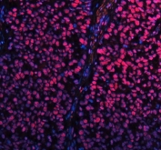 Immunofluorescent staining of FFPE human non-small cell carcinoma tissue with SP1 antibody (red) and DAPI nuclear stain (blue). HIER: steam section in pH8 EDTA buffer for 20 min..