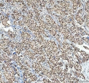 IHC staining of FFPE human ovarian cancer tissue with SP1 antibody. HIER: boil tissue sections in pH8 EDTA for 20 min and allow to cool before testing.