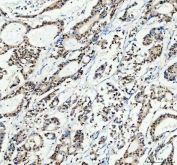 IHC staining of FFPE human colorectal adenocarcinoma tissue with SP1 antibody. HIER: boil tissue sections in pH8 EDTA for 20 min and allow to cool before testing.