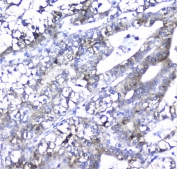 IHC staining of FFPE human liver cancer with Alpha 1 microglobulin antibody at 1ug/ml. HIER: boil tissue sections in pH6, 10mM citrate buffer, for 10-20 min followed by cooling at RT for 20 min.