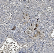 IHC staining of FFPE human liver cancer tissue with C Reactive Protein antibody. HIER: boil tissue sections in pH8 EDTA for 20 min and allow to cool before testing.