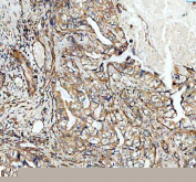 IHC staining of FFPE human lung adenocarcinoma tissue with ADAM10 antibody, HRP-secondary and DAB substrate. HIER: boil tissue sections in pH8 EDTA for 20 min and allow to cool before testing.