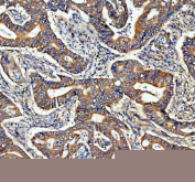 IHC staining of FFPE human rectum adenocarcinoma tissue with ADAM10 antibody, HRP-secondary and DAB substrate. HIER: boil tissue sections in pH8 EDTA for 20 min and allow to cool before testing.