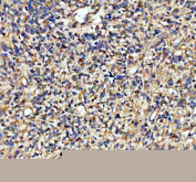 IHC staining of FFPE human glioblastoma tissue with ADAM10 antibody, HRP-secondary and DAB substrate. HIER: boil tissue sections in pH8 EDTA for 20 min and allow to cool before testing.