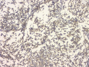 IHC staining of FFPE human glioma with APP antibody at 1ug/ml. HIER: boil tissue sections in pH6, 10mM citrate buffer, for 10-20 min and allow to cool before testing.