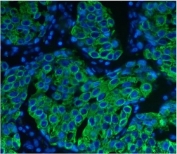 Immunofluorescent staining of FFPE human breast cancer with Keratin 8 antibody (green) and DAPI nuclear stain (blue). HIER: steam section in pH8 EDTA for 20 min.