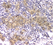 IHC staining of FFPE human breast cancer with APRT antibody at 1ug/ml. HIER: boil tissue sections in pH6, 10mM citrate buffer, for 10-20 min and allow to cool before testing.