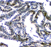 IHC staining of FFPE human intestinal cancer with NFIA antibody. HIER: boil tissue sections in pH8 EDTA for 20 min and allow to cool before testing.