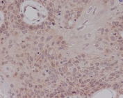 IHC staining of FFPE human cervical carcinoma with ER alpha antibody. HIER: boil tissue sections in pH6, 10mM citrate buffer, for 10-20 min and allow to cool before testing.