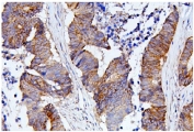 IHC staining of FFPE human colon cancer with CDC42 antibody. HIER: boil tissue sections in pH8 EDTA for 20 min and allow to cool before testing.