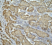 IHC staining of FFPE human breast cancer with LONP1 antibody. HIER: boil tissue sections in pH6, 10mM citrate buffer, for 20 min and allow to cool before testing.