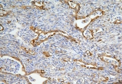 IHC staining of FFPE human rectal cancer with LONP1 antibody. HIER: boil tissue sections in pH6, 10mM citrate buffer, for 20 min and allow to cool before testing.