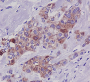 IHC staining of FFPE human breast carcinoma tissue with Phospho-Tau antibody, HRP-secondary and DAB substrate. HIER: boil tissue sections in pH8 EDTA for 20 min and allow to cool before testing.