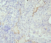 IHC staining of FFPE human lung cancer with eNOS antibody. HIER: boil tissue sections in pH6, 10mM citrate buffer, for 20 min and allow to cool before testing.
