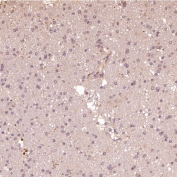 IHC staining of FFPE human glioblastoma tissue with HAPLN1 antibody at 1:50. HIER: boil tissue sections in pH6 citrate buffer for 20 min and allow to cool before testing.