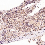 IHC staining of FFPE human thyroid cancer tissue with BiP antibody. HIER: boil tissue sections in pH6, 10mM citrate buffer, for 10-20 min followed by cooling at RT for 20 min.