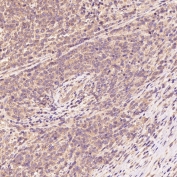 IHC staining of FFPE non-Hodgkin's Lymphoma tissue with BiP antibody. HIER: boil tissue sections in pH6, 10mM citrate buffer, for 10-20 min followed by cooling at RT for 20 min.