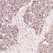 IHC staining of FFPE human prostate cancer tissue with BiP antibody. HIER: boil tissue sections in pH6, 10mM citrate buffer, for 10-20 min followed by cooling at RT for 20 min.
