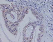 IHC staining of FFPE human ovarian cancer with BRAF antibody. HIER: boil tissue sections in pH6, 10mM citrate buffer, for 10-20 min and allow to cool before testing.