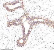 IHC staining of FFPE human breast cancer tissue with EpCAM antibody. HIER: boil tissue sections in pH8 EDTA for 20 min and allow to cool before testing.
