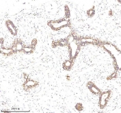 IHC staining of FFPE human breast cancer tissue with EpCAM antibody. HIER: boil tissue sections in pH8 EDTA for 20 min and allow to cool before testing.