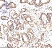 IHC staining of FFPE human colon cancer tissue with EpCAM antibody. HIER: boil tissue sections in pH8 EDTA for 20 min and allow to cool before testing.