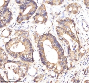 IHC staining of FFPE human colon cancer tissue with EpCAM antibody. HIER: boil tissue sections in pH8 EDTA for 20 min and allow to cool before testing.