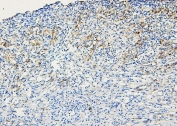 IHC staining of FFPE human melanoma with ABCB5 antibody. HIER: boil tissue sections in pH6, 10mM citrate buffer, for 20 min and allow to cool before testing.