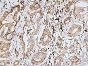 IHC staining of FFPE human intestinal cancer with SDHB antibody. HIER: boil tissue sections in pH6, 10mM citrate buffer, for 20 min and allow to cool before testing.