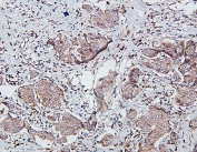 IHC staining of FFPE human breast cancer with SDHB antibody. HIER: boil tissue sections in pH6, 10mM citrate buffer, for 20 min and allow to cool before testing.