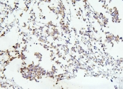 IHC staining of FFPE human glioma with DCC antibody. HIER: boil tissue sections in pH6, 10mM citrate buffer, for 20 min and allow to cool before testing.