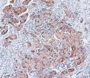 IHC staining of FFPE human breast cancer with COMT antibody. HIER: boil tissue sections in pH6, 10mM citrate buffer, for 20 min and allow to cool before testing.