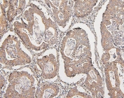 IHC staining of FFPE human intestinal cancer with COMT antibody. HIER: boil tissue sections in pH6, 10mM citrate buffer, for 20 min and allow to cool before testing.