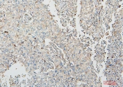 IHC staining of FFPE human lung cancer with COMT antibody. HIER: boil tissue sections in pH6, 10mM citrate buffer, for 20 min and allow to cool before testing.