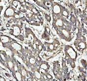 IHC staining of FFPE human lung cancer tissue with NOTCH2 antibody. HIER: boil tissue sections in pH8 EDTA for 20 min and allow to cool before testing.