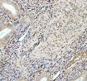 IHC staining of FFPE endometrial cancer tissue with Fox2 antibody. HIER: boil tissue sections in pH8 EDTA for 20 min and allow to cool before testing.