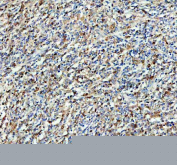 IHC staining of FFPE human lymphoma tissue with SYK antibody, HRP-secondary and DAB substrate. HIER: boil tissue sections in pH8 EDTA for 20 min and allow to cool before testing.