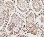 IHC staining of FFPE human intestinal cancer with Calreticulin antibody. HIER: boil tissue sections in pH6, 10mM citrate buffer, for 20 min and allow to cool before testing.