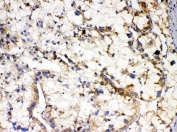 IHC staining of FFPE human liver cancer with APOL1 antibody. HIER: boil tissue sections in pH6, 10mM citrate buffer, for 20 min and allow to cool before testing.