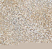 IHC staining of FFPE human liver cancer tissue with Beta Glucuronidase antibody, HRP-secondary and DAB substrate. HIER: boil tissue sections in pH8 EDTA for 20 min and allow to cool before testing.