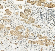 IHC staining of FFPE human breast cancer with ATRX antibody (nuclear and cytoplasmic staining seen here). HIER: boil tissue sections in pH6, 10mM citrate buffer, for 20 min and allow to cool before testing.