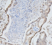 IHC staining of FFPE human colon cancer with UBC9 antibody. HIER: boil tissue sections in pH6, 10mM citrate buffer, for 20 min and allow to cool before testing.